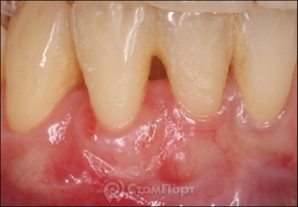 Reconstrucția septului osos interdental cu eliminarea recesiunii gingiei