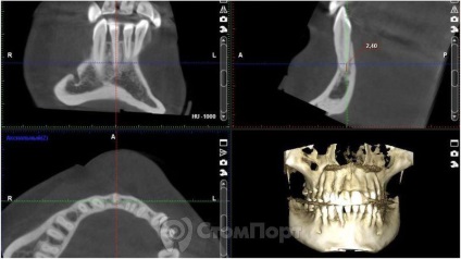 Reconstrucția septului osos interdental cu eliminarea recesiunii gingiei