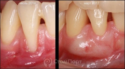 Reconstrucția septului osos interdental cu eliminarea recesiunii gingiei