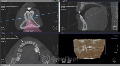 Reconstrucția septului osos interdental cu eliminarea recesiunii gingiei