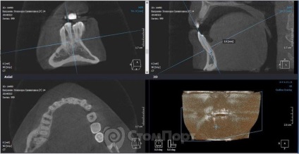 Reconstrucția septului osos interdental cu eliminarea recesiunii gingiei