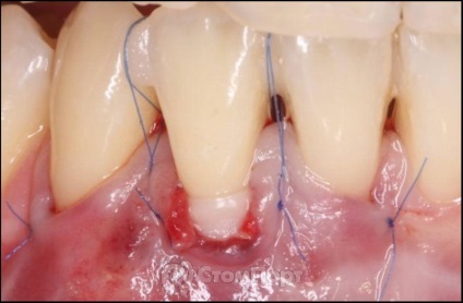 Reconstrucția septului osos interdental cu eliminarea recesiunii gingiei