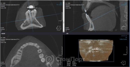 Reconstrucția septului osos interdental cu eliminarea recesiunii gingiei