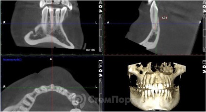 Reconstrucția septului osos interdental cu eliminarea recesiunii gingiei