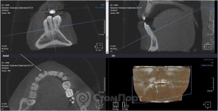 Reconstrucția septului osos interdental cu eliminarea recesiunii gingiei