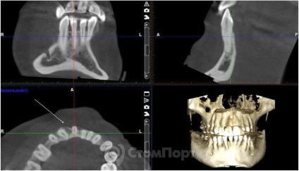 Reconstrucția septului osos interdental cu eliminarea recesiunii gingiei