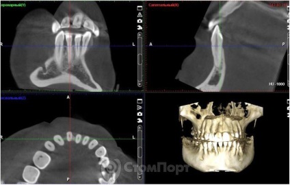 Reconstrucția septului osos interdental cu eliminarea recesiunii gingiei