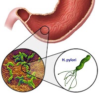 Helicobacter pylori este foarte gravă, întotdeauna în formă!