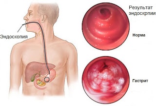 Helicobacter pylori este foarte gravă, întotdeauna în formă!