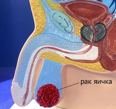 Chimioterapia pentru cancerul testicular ᐈ Tratamentul la Kiev