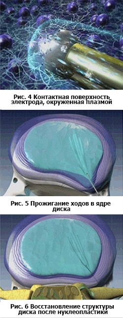 Холодноплазменная нуклеопластіка, ріц - російсько-ізраїльський центр мікрохірургії хребта