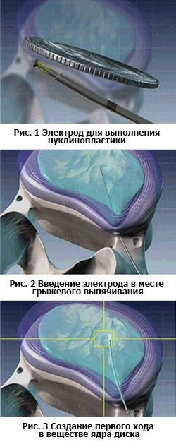 Aparatură nucleoplastică cu plasmă rece, ric - centru ruso-israelian pentru microchirurgie spinală