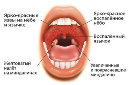 Ulcero-necrotic angina simptome și tratament antibiotic