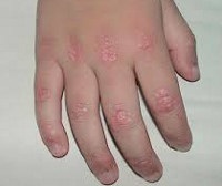 Dermatomiozita juvenilă - cauze, simptome, diagnostic și tratament