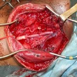 Boli ale aortei cavității abdominale - bisturiu - informații medicale și portal educațional