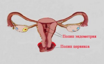 Fibroza glandulară a canalului cervical