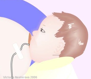 Sondă de alimentare pentru nou-născuți, nou-născut