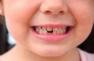 Dinții din copil cresc un al doilea rând (rădăcină în spatele laptelui) dacă trebuie îndepărtat