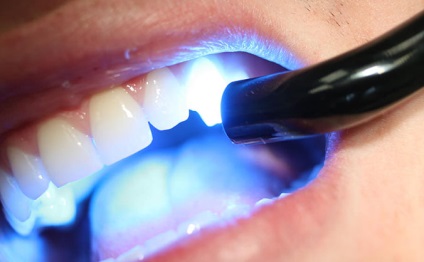 10 Tipuri moderne de beneficii și rău pentru albirea dinților