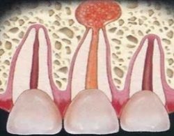 Abcesul simptomelor dintelui și tratamentul abcesului purulen al dinților