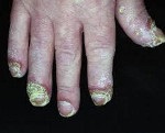 Acerodermatitis allopo - cauze, simptome, diagnostic și tratament