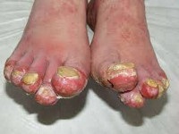 Acerodermatitis allopo - cauze, simptome, diagnostic și tratament