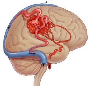 Alformațiile vaselor cerebrale ce este, cum se tratează