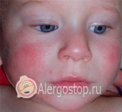 Alergii la cosmetice pentru un copil - alergii