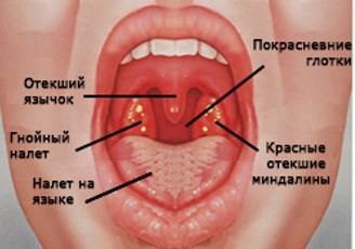 Angina este contagioasă sau nu pentru alții, câte zile