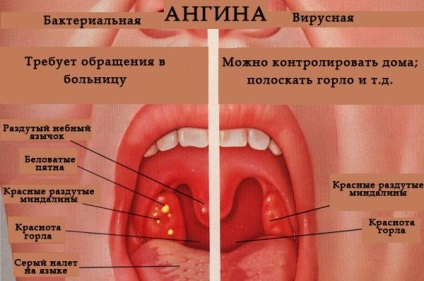 Angina este contagioasă sau nu pentru alții, câte zile