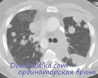 Malformații pulmonare arteriovenoase