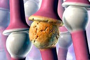 Arthritis az ízületek a láb - okai, tünetei és kezelése láb arthritis, cikkek