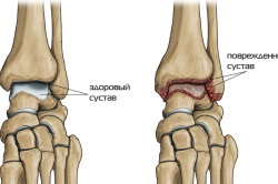 Osteoartrita simptomelor și tratamentului gleznei, cauzele bolii (video)