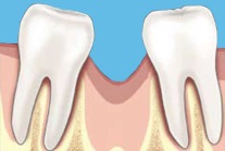 Atrofia țesutului osos, probleme cu dinții, stomatologie inteligibilă pentru pacienții diagnosticați online,