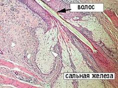 Bariere împotriva infecțiilor - o caracteristică a imunologiei