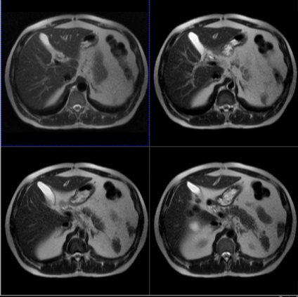 Mi jobb MRI vagy CT vizsgálat a has