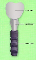 Що таке абатмент в імплантації зубів
