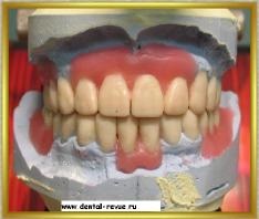 Dental-revü, fotók, klinikai eset №7 gyártási titán csonkot lapok