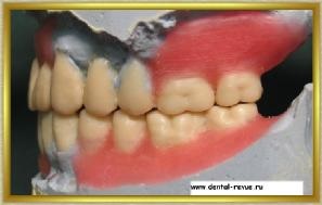 Dental-revü, fotók, klinikai eset №7 gyártási titán csonkot lapok