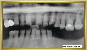 Dental-revü, fotók, klinikai eset №7 gyártási titán csonkot lapok