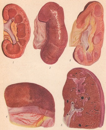 Eclampsia - site medical