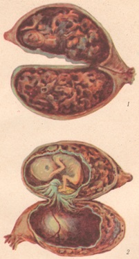 Eclampsia - site medical