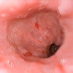 Eroziunea esofagului - simptome, tratament, remedii populare