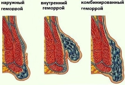 Hemoroizii și factorii de dezvoltare ai prostatitei și influența reciprocă