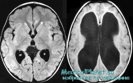 Hidrocefalia la copii și nou-născuți - diagnostice CT