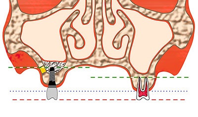 Az implantáció hiányában fogak