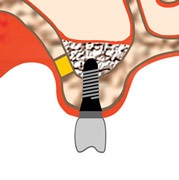 Az implantáció hiányában fogak