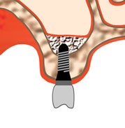 Az implantáció hiányában fogak