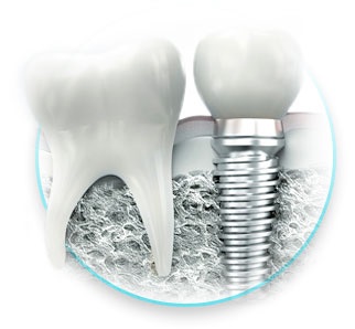 Implantarea dinților cu absența completă a dinților