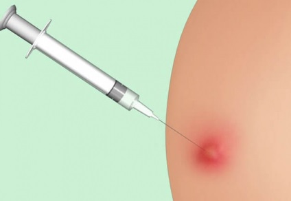 Cum se pot vindeca rapid conurile dupa injectii pe fese